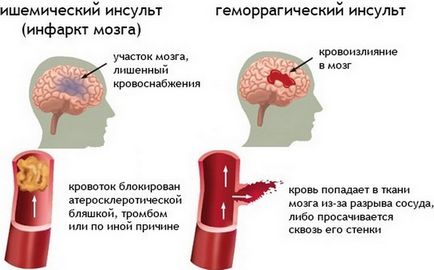 Accident vascular cerebral ischemic provoacă dezvoltarea bolii, tratamentul, prevenirea