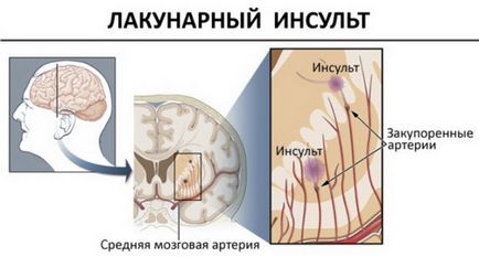 Accident vascular cerebral ischemic provoacă dezvoltarea bolii, tratamentul, prevenirea