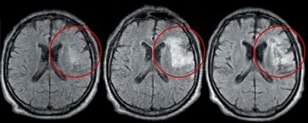 Ischaemiás stroke-ot okoz a betegség, a kezelés, megelőzés