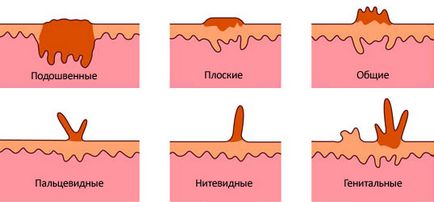 Як позбутися від папілом народними засобами