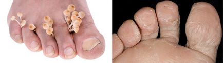 Як лікувати грибок нігтів на ногах причини, ознаки, лікування нігтьового грибка