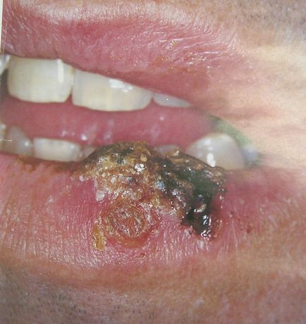 Cum arată cavitatea orală atunci când există modificări ale apariției bolii gurii cu HIV