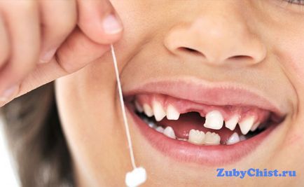 Як вирвати молочний зуб - нюанси видалення у дітей