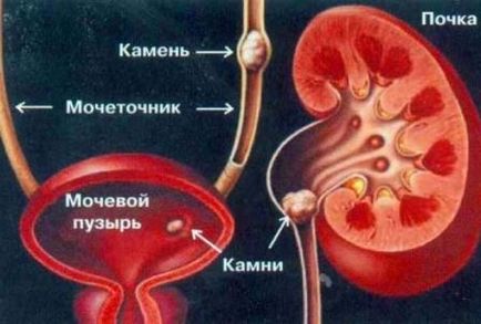 Камені в нирках, народне лікування