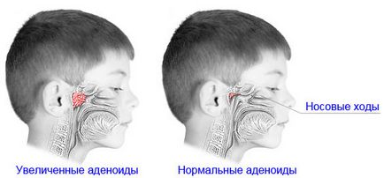 Tuse în adenoizi la copii, tratament, simptome, prevenție, tuse