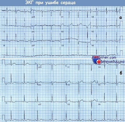 Clinica, diagnosticul traumatismului cardiac abrupt