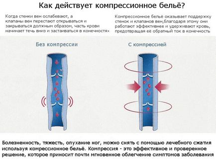 Компресійні панчохи сігваріс - переваги і протипоказання до застосування