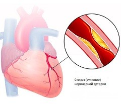 Stentul coronarian al vaselor inimii