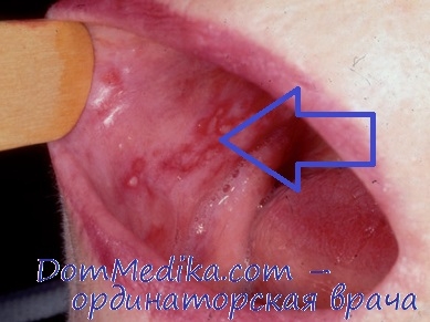 Roșu lichen al cavității bucale - diagnostic, tratament