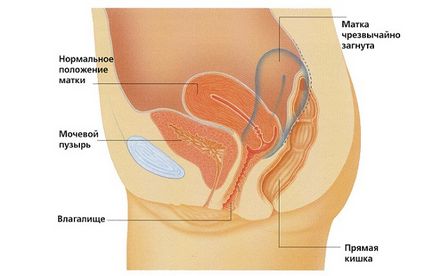 Exerciții terapeutice cu îndoirea posterioară a uterului