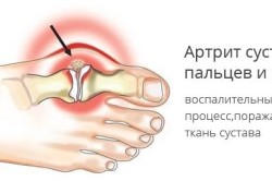 Tratamentul artritei piciorului la domiciliu