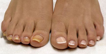 Tratamentul ciupercii unghiilor de la picioare pentru o mamă care alăptează
