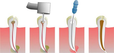 Tratamentul canalelor canalului sub microscop