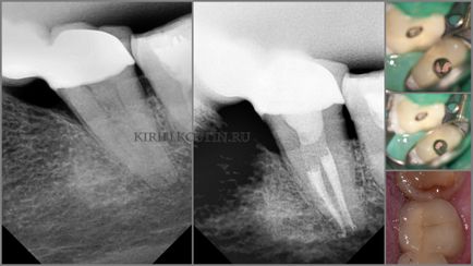 Лікування каналів зубів з мікроскопом