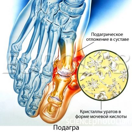 Лікування подагри - медичний портал eurolab