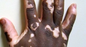 A kezelés a vitiligo fekete kömény olaj