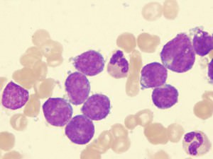 Leucemia - cauze, simptome, tratament