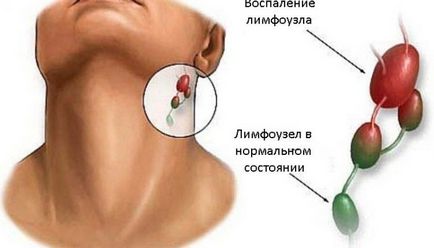 лечение лимфаденит което антибиотици