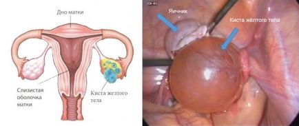 Chistul chistului ovarian, consecințele, complicațiile, riscurile de ruptură