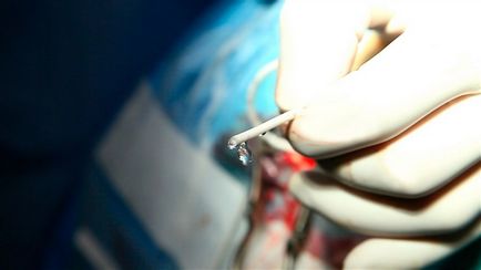 Operație by-pass lombaritoneală