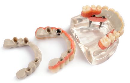 Матеріал peek (пік, пеек) в стоматології