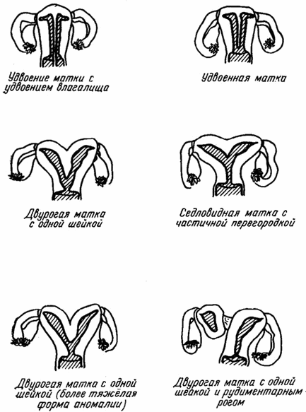 Матка, аномалії розвитку статевих органів, дитяча гінекологія