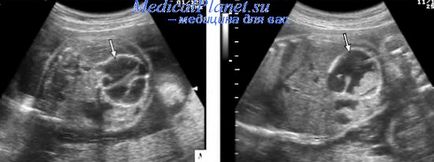 meconium peritonitis