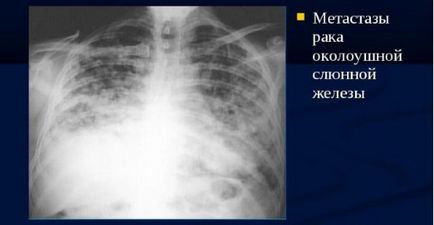 Metastazele din plămâni pe raze x - cum arată ele