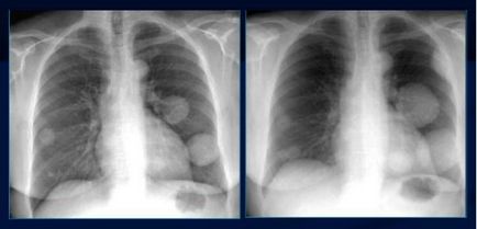 Metasztázisok tüdő röntgen - a megjelenés