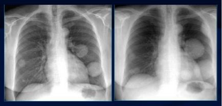Метастази в рентген на бял дроб - на външния вид