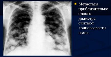 Metastazele din plămâni pe raze x - cum arată ele