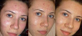 A mechanikai tisztítás, az arc, mint az egyik leghatékonyabb kezelési bőrápolás