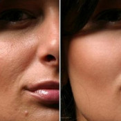 Mesoterapie indicații faciale, fotografie înainte și după, efect, metode alternative