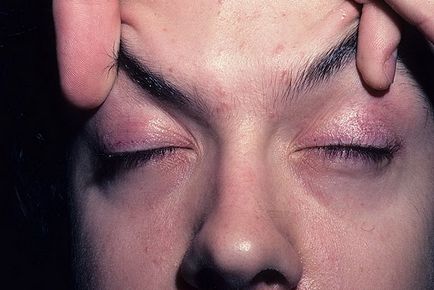 Myosita simptomelor și cauzelor mușchilor oculari