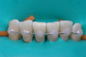 Pot instala implanturi dentare cu boală parodontală?