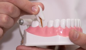 Pot instala implanturi dentare cu boală parodontală?
