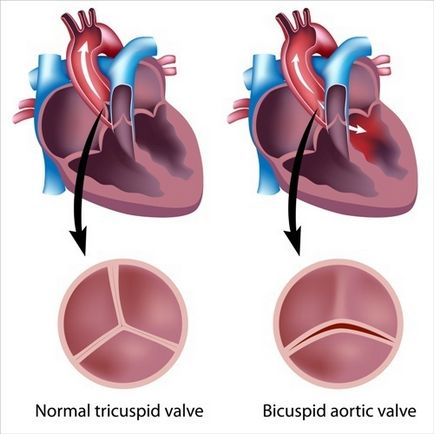 Aortic valve de deficiență simptome, diagnostic, tratament