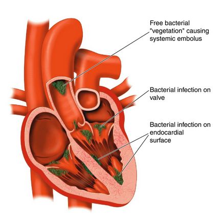 Aortic valve de deficiență simptome, diagnostic, tratament