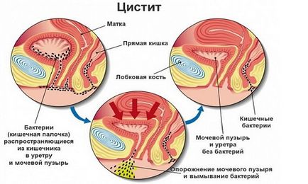 Nolitsin cu cistită și pielonefrită instrucțiuni de utilizare, indicații, contraindicații