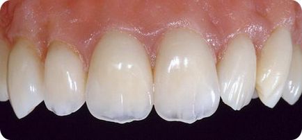 Оксид цирконію в стоматології