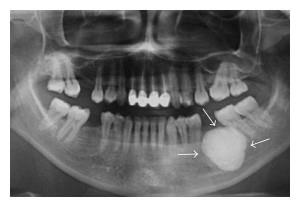 Descrierea osteomului maxilarului inferior