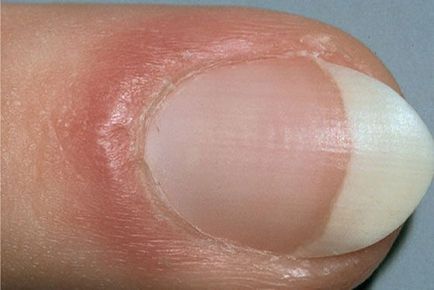 Definiți bolile unghiilor