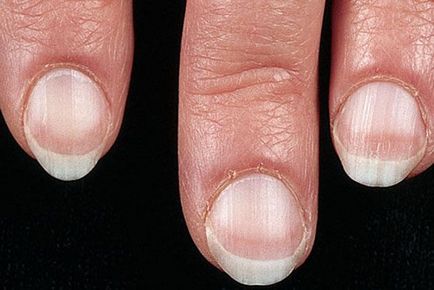 Визначаємо хвороби по нігтях