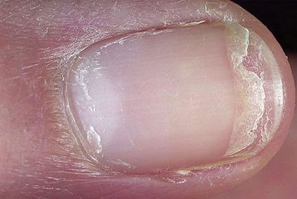 Визначаємо хвороби по нігтях