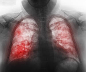 Complicațiile de pneumonie - semne și tratament