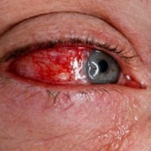 Complicații după înlocuirea lentilei ochiului cu cataractă