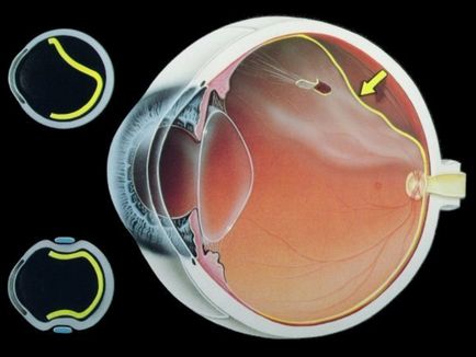 Complicații după înlocuirea lentilei ochiului cu cataractă