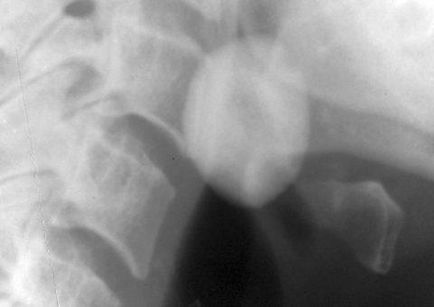 Osteomul cauzat de maxilarul inferior și consecințele acestuia
