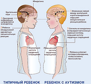 Osteopathic ellátás autista gyermekek