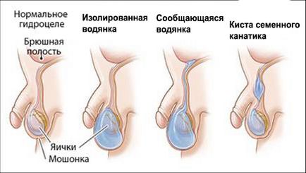 Departamentul de Urologie Pediatrica, Andrologie si Chirurgie Routina dgkb Nr. 13 ova - edemul cojilor de testicule